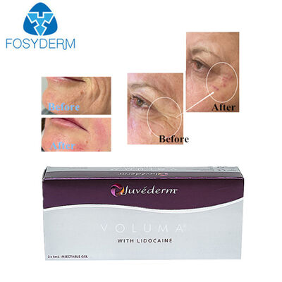 Juvederm Hyaluronic Acid Dermal Filler Voluma Face Lifting 2*1ml