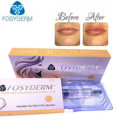 Hyaluronic Acid Dermal Filler Anti Wrinkles Face Lifting 1ml 2ml