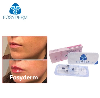 Gel Fosyderm 2ml Cross Linked Hyaluronic Acid Dermal Filler For Lip Enhancement