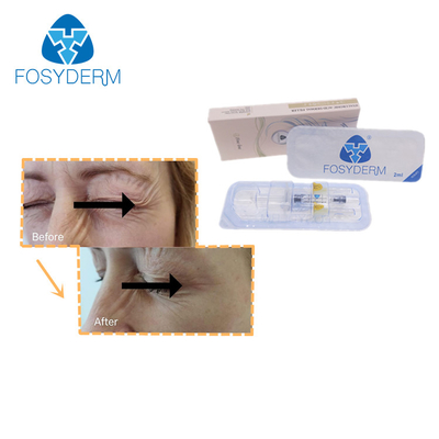 Fosyderm Cross Linked HA Filler 2ml Fine Line Hyaluronic Acid For Eye Wrinkles