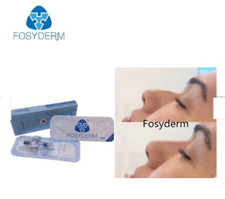 Fosyderm Cross linked Deep Line Filler 2ml Dermal filler for Nose Up