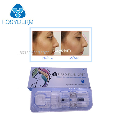 Fosyderm 1ml Hyaluronic Acid Dermal Filler Injections To Increase Lips Size