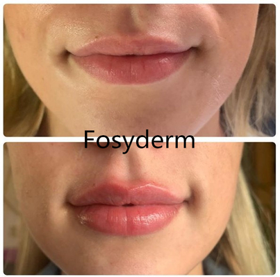 1.1ml Derm Dermal Lip Fillers Hyaluronic Acid Injectable Face Filler