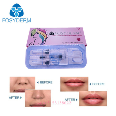 Facial Wrinkle Ha Gel Dermal Filler Injectable Hyaluronic Acid Filler For Lips
