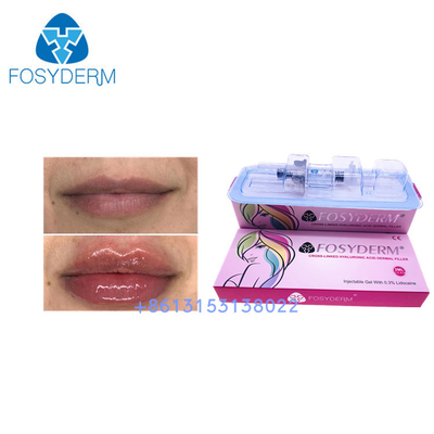 24 Mg/Ml Fosyderm Facial Filler HA Dermal Filler Hyaluronic Acid Gel Injections