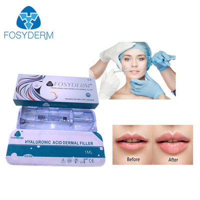 1ml Lip Dermal Filler Injections Cross Linked Hyaluronic Acid