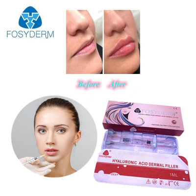 Injectable Hyaluronic Acid Dermal Lip Filler 1ml / 2ml