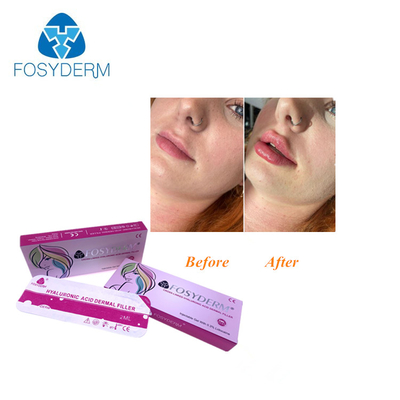 Hyaluronic Acid Dermal Injectable Filler For Nose Face