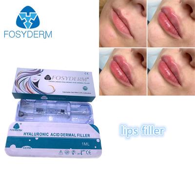 Filling Face Injection Fosyderm Fosyderm Hyaluronic Acid Lip Fillers 1ml