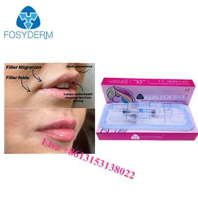 Lip Cheek And Nasolabial Dermal Filler Hyaluronic acid Ha Injections 1ml 2ml 5ml