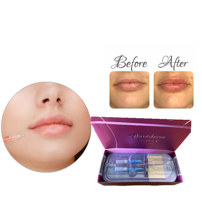 Hyaluronic Acid Dermal Filler Juvaderm Ultra3 Ultra4 Voluma For Glabellar