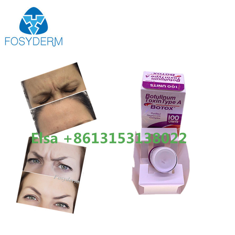 Botulinum Toxin Type A s Dermal Filler Anti Wrinkle Face Injectable