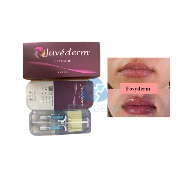 Voluma Hyaluronic Acid Dermal Filler Fosyderm For Lip Enhancement