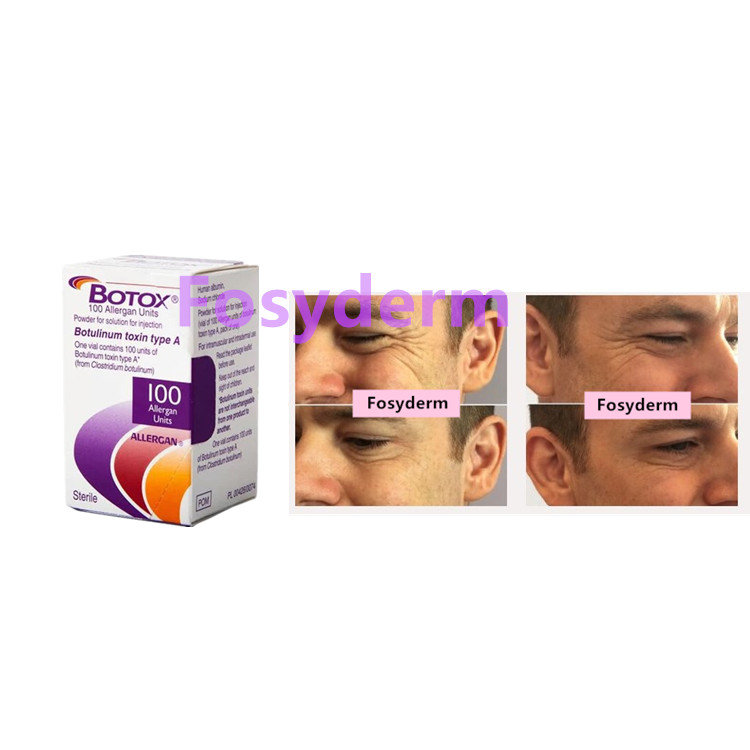 100units Botulinum Toxin Allergan Anti Wrinkles Injection  Type A