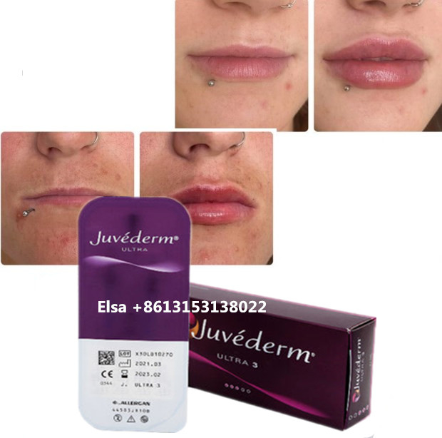 Cosmetics Skin Care Injections Lip Plumper Juvederm Filler Injection For Nose Chin Lip