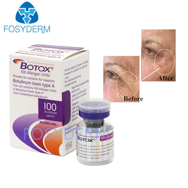 Type A 100 Units Allergan Botulinum Toxin Dermal Filler Hyaluronic Acid