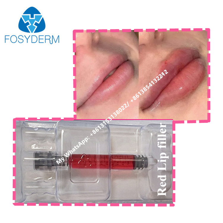 Red Lip Filler With Vitamin B12 Hyaluronic Acid Filler Gel For Lips