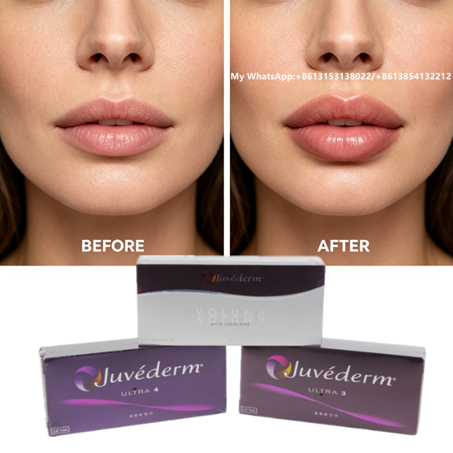 Juvederm Dermal Filler Gel Injection HA Filler For Smoother Fuller Skin 2×1ml