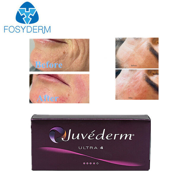Hyaluronic Acid Dermal Filler Face Lifting Anti Wrinkles 1ml 2ml