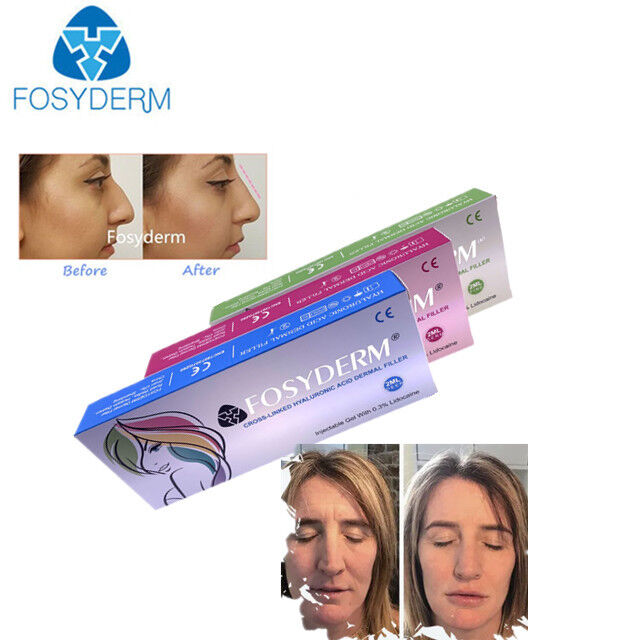 Hyaluronic Acid Dermal Filler Anti Wrinkles Nose Up Lips Augmentation