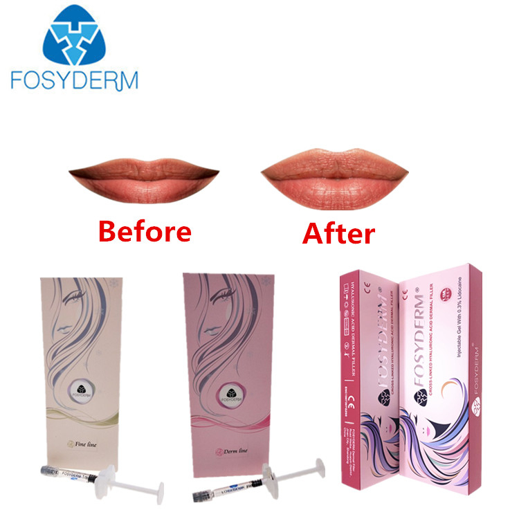 Wrinkles And Lips Hyaluronic Acid Injectable Filler With Lidocaine