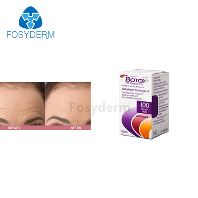100 Units Allergan  Botulinum Toxin Injection For Anti Wrinkles
