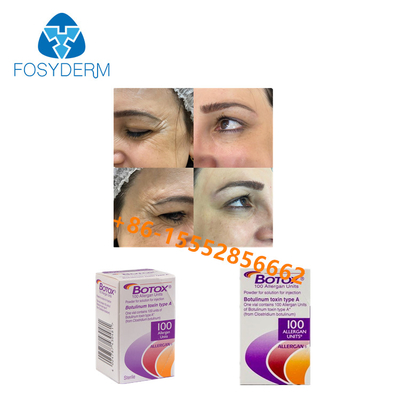 Remove Wrinkles Botulinum Toxin 100 Units Allergan  Type A