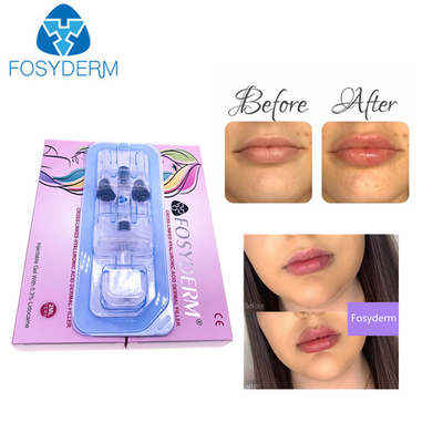 CE Certification 1ml Deep Hyaluronic Acid Derm HA Dermal Filler For Lips
