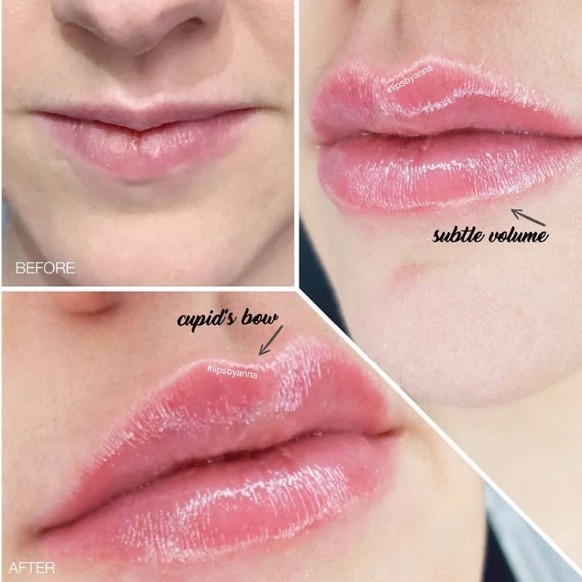 Long Lasting Lip Plumper Hyaluronic Acid Dermal Filler Gel Injection 24mg