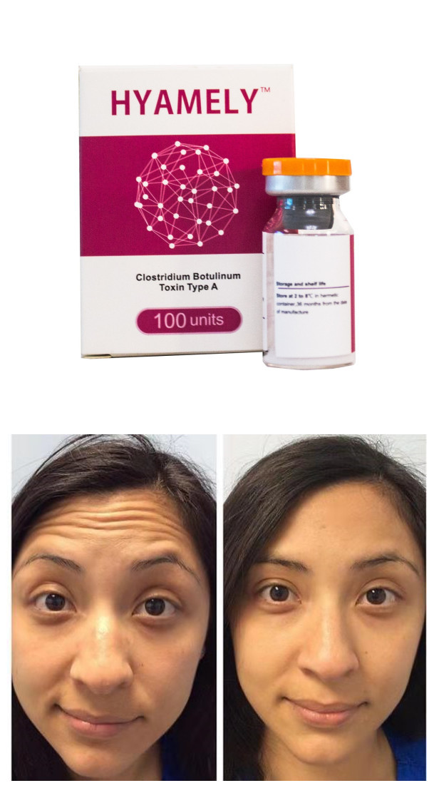 Botulium Toxin Type A Botox Anti Wrinkles Powder Injection 100 Units