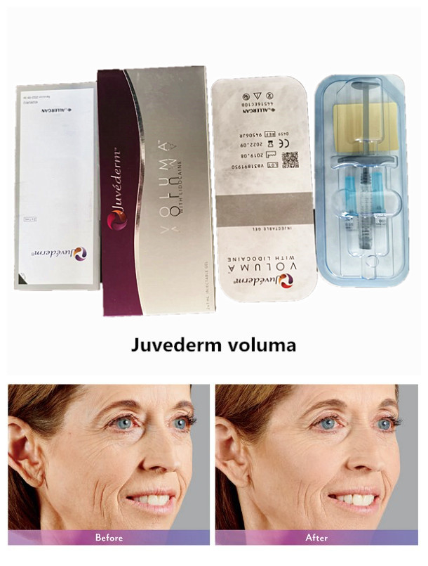 Ultra3 2*1ml Syringe Juvederm Hyaluronic Acid