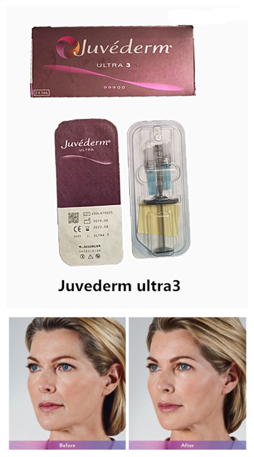 Ultra3 2*1ml Syringe Juvederm Hyaluronic Acid