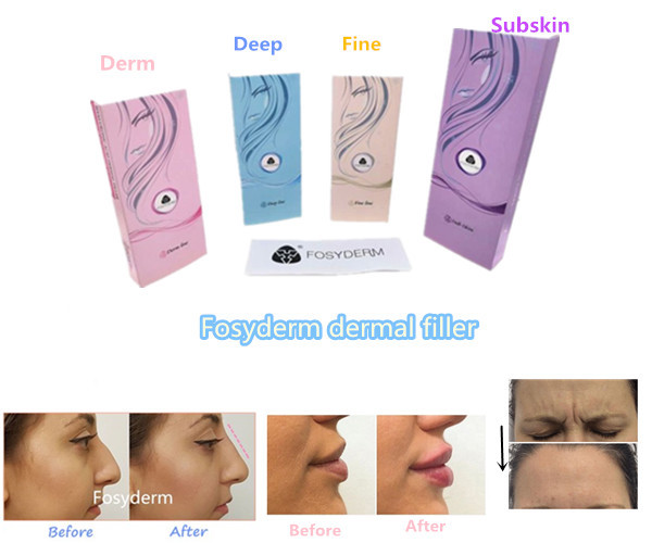 10ml 20ml Hyaluronic Acid Injections For Breast Enlargemnt